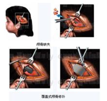 人工顱骨