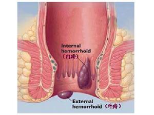 靜脈曲張性外痔
