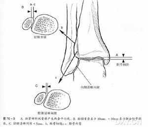 踝部骨折