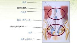 腹股溝疝修補術