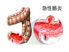 直腸炎