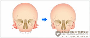 顴骨整形