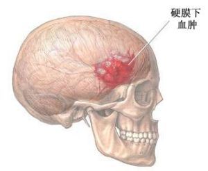 骨切開術