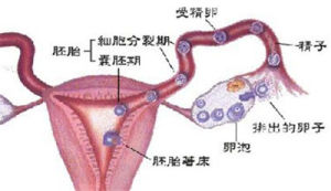 持續性異位妊娠