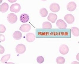 嗜鹼性點彩紅細胞：增多見於鉛中毒等。