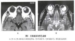 睫狀體黑色素瘤