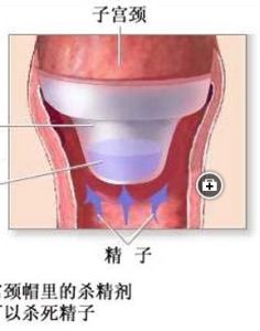 女性結紮