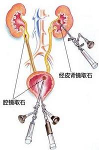 腎結石微創手術