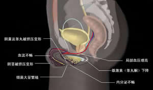 原發性精囊癌