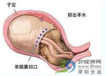 羊膜囊