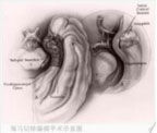 線粒體腦肌病