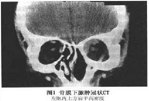 眶骨膜下膿腫