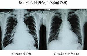 老年缺血性心肌病