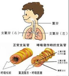 小兒過敏性哮喘