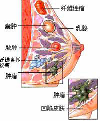 （圖）遺傳性乳腺癌-卵巢癌綜合徵