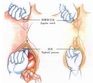 示意圖12:推開兩側縱隔胸膜，使之貫通