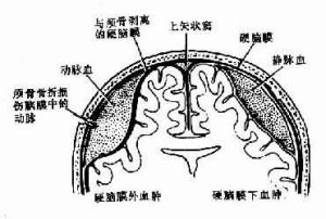 硬腦膜外血腫