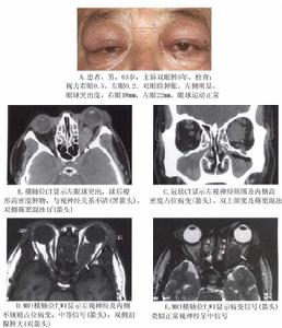 眼眶炎性假瘤