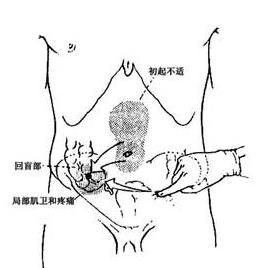 闌尾炎