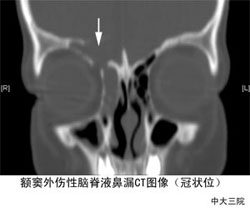 腦垂體瘤