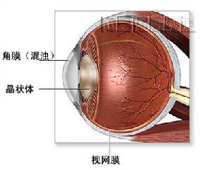 綠膿桿菌性角膜潰瘍