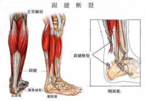 跟腱撕裂