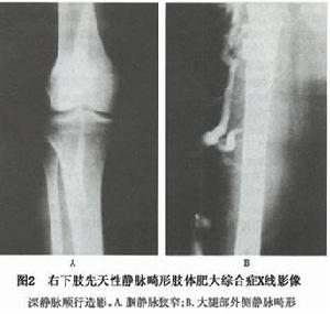 先天性靜脈畸形肢體肥大綜合徵