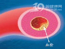 四肢血栓性淺靜脈炎