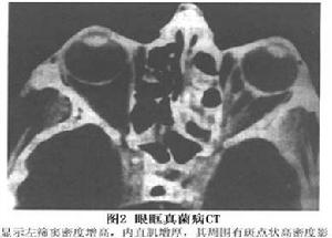 眼眶真菌病