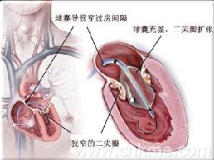 老年鈣化性心臟瓣膜病