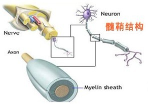 慢性炎症性脫髓鞘性多發性神經病