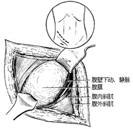 圖3:顯露腹壁下的動脈和靜脈(示意圖)