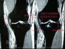 後關節盂成形術