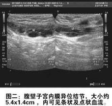 腹壁子宮內膜異位症