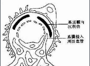 系統性紅斑狼瘡性腎炎