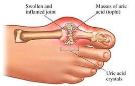 痛風併發症
