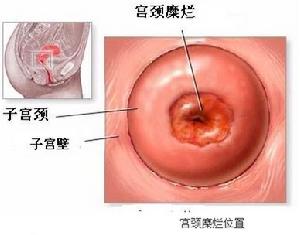 子宮頸糜爛