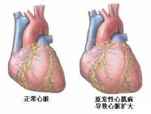 慢性心力衰竭