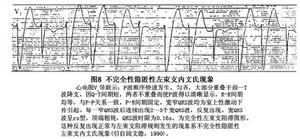 左束支傳導阻滯