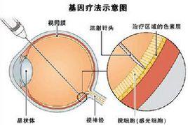 先天性黑蒙症