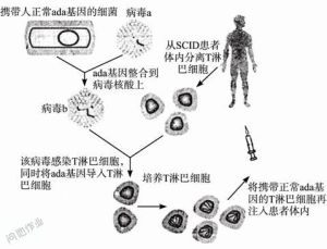 嚴重複合型免疫缺乏症