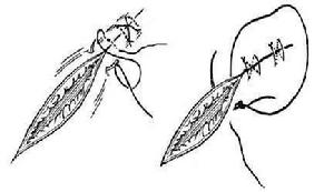 兩種8字縫合法