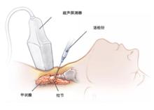 甲狀腺活檢