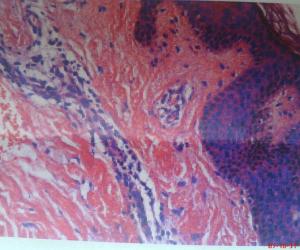 （圖）皮下脂膜炎性T細胞淋巴瘤