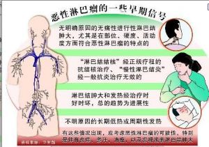 惡性淋巴瘤