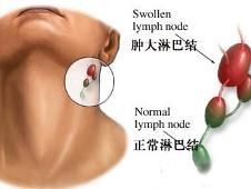 頸部淋巴結腫大