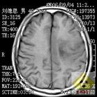 膠質母細胞瘤細胞