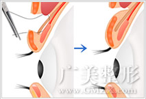 重瞼手術