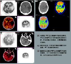 賓斯旺格病