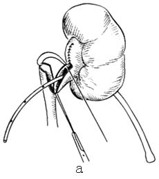 慢性反流性腎病